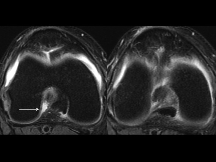 Figure 1 for case anterior cruciate ligament ( RID2781 )